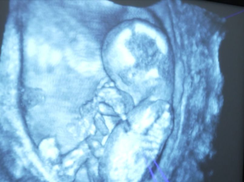 Door hologram-echo zijn afwijkingen ongeboren kind beter te begrijpen voor ouders