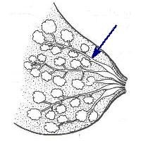 Borstvoeding Melkkanalen-en-Borstontsteking