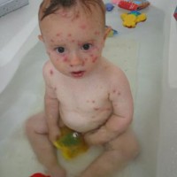 Kinderziektes Waterpokken