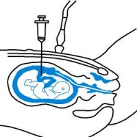 Tests Tijdens De Zwangerschap Navelstrengpunctie