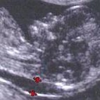 Tests Tijdens De Zwangerschap De-Combinatietest