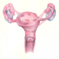 Endometriose 