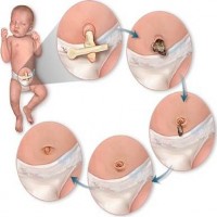 Babyverzorging Navelstompje